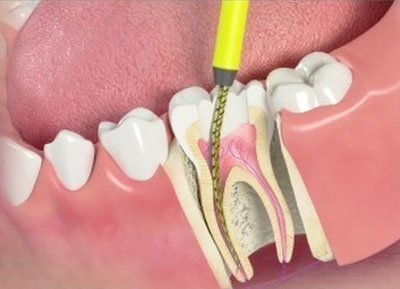 Лечение пульпита и периодонтита молочных зубов