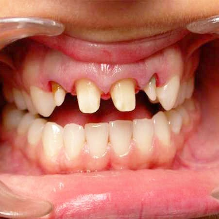 Разрушение зуба