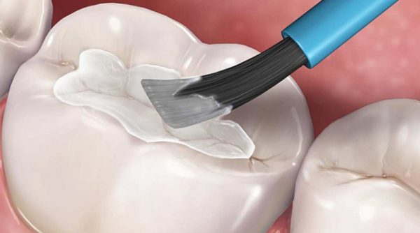 Профилактика различных стоматологических заболеваний