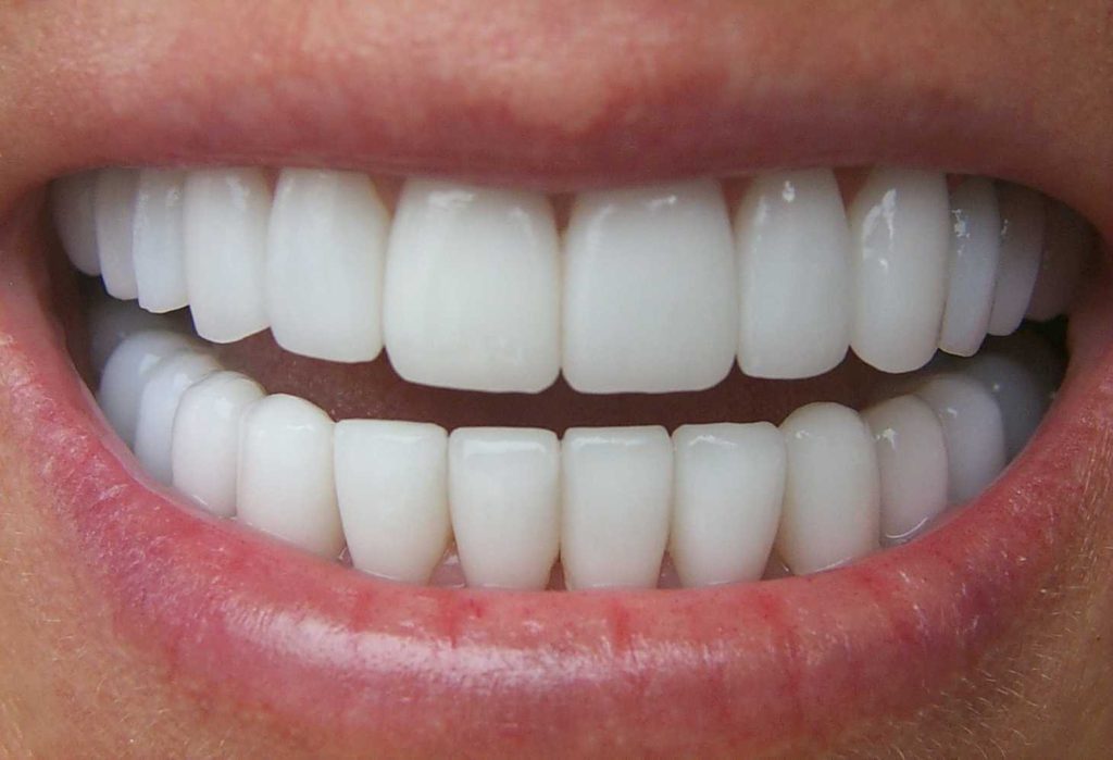 implants cosmetic dentist maple ridge bc e1560003165849