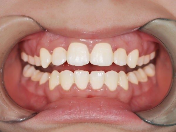 Исправление положения зубов